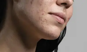 Primo piano del viso di una donna con acne. La resorcina cos'è? Un trattamento per la pelle.