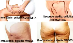 Le immagini mostrano i quattro stadi della cellulite, da compatta a edematosa, molle e fibrosa. La cellulite fa male e può peggiorare con il tempo.