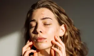 Ragazza con brufoli che si gode la luce del sole, sperando che il sole faccia bene ai brufoli.