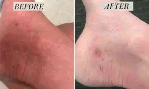 Piede prima e dopo: la pelle secca e screpolata migliora. Attenzione, le creme all'urea fanno male se usate impropriamente.