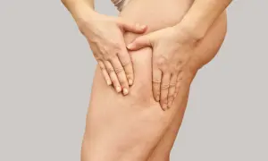 Mani che stringono la coscia, evidenziando la **cellulite acquosa** e la texture della pelle.