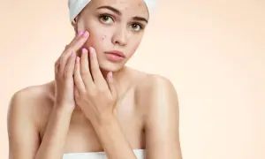 Ragazza con imperfezioni sul viso, preoccupata. Cerca una soluzione non comedogena per la sua pelle.