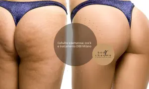 Confronto prima/dopo: la pelle mostra i diversi tipi di cellulite, con un miglioramento visibile grazie al trattamento DIBI Milano.