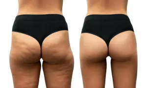 Confronto prima/dopo: la gamba sinistra mostra cellulite dolorosa e irregolarità, la destra appare liscia e tonica.