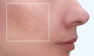 Pelle con pori dilatati e segni, un esempio di come avere la pelle liscia e senza imperfezioni con trattamenti mirati.