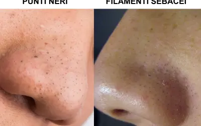 Confronto tra punti neri e filamenti sebacei sul naso. Scopri come togliere i punti neri per una pelle più liscia.
