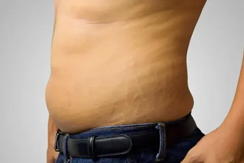 Primo piano della pancia di un uomo con smagliature visibili, evidenziando la texture della pelle.