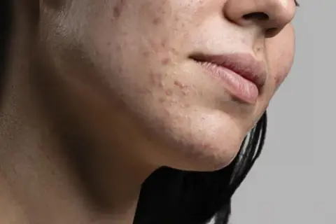 Primo piano del viso di una donna con acne. La resorcina cos'è? Un trattamento per la pelle.