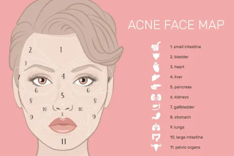 Mappa del viso per l'acne: i brufoli sulla mandibola (zona 9) potrebbero indicare problemi intestinali.