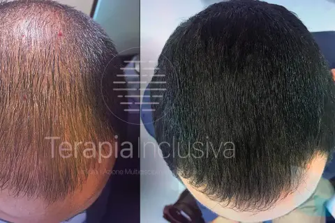 Prima e dopo: un uomo mostra come far ricrescere i capelli con un trattamento che ha ridensificato la chioma, eliminando la calvizie.