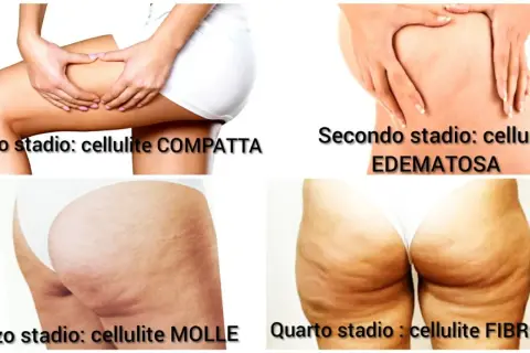 Le immagini mostrano i quattro stadi della cellulite, da compatta a edematosa, molle e fibrosa. La cellulite fa male e può peggiorare con il tempo.