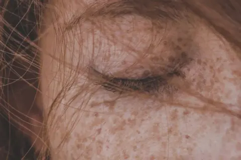 Primo piano di un occhio chiuso con capelli castani che sfiorano il viso. Le **macchie solari sulla pelle** creano un disegno naturale e unico.