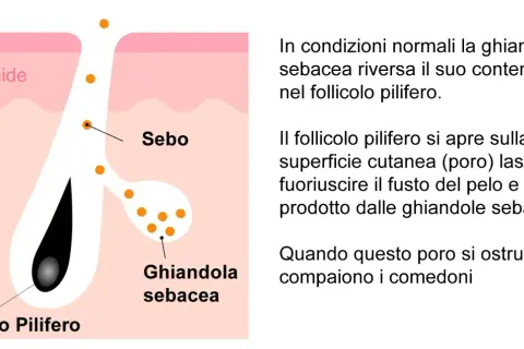 Diagramma della pelle che mostra un follicolo pilifero e una ghiandola sebacea. Punti neri giganti indicano l'accumulo di sebo.
