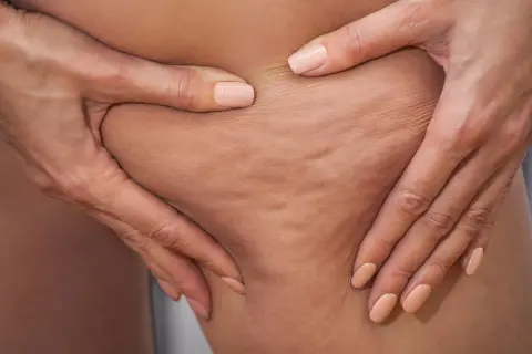 Mani che pizzicano la pelle mostrando la cellulite sclerotica, con unghie smaltate color pesca.