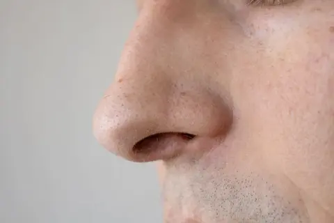 Primo piano del naso di un uomo, con pori dilatati visibili sulla pelle.