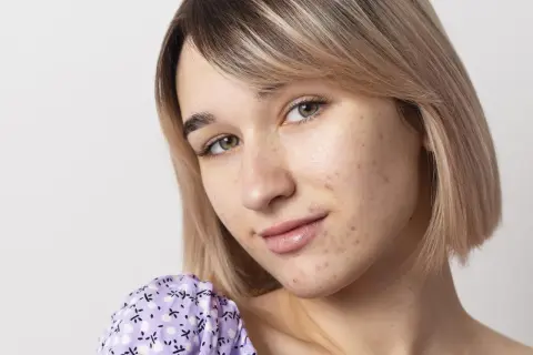 Primo piano di una giovane donna con brufoli da stress sul viso. Impara a riconoscerli e a gestirli.