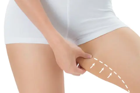 Mano che pizzica la pelle flaccida interno coscia, con frecce bianche che indicano un'area da trattare.