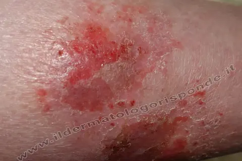 Macchie infiammate e screpolate sulle gambe, con aree arrossate e desquamazione.