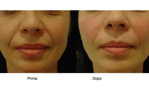 Prima e dopo: il contorno labbra è più definito e le rughe naso-labiali meno evidenti, dimostrando che l'acido ialuronico per bocca funziona.