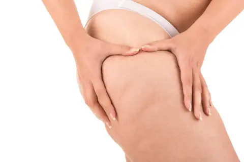 Mani che stringono la coscia per rompere i noduli di cellulite, mostrando la texture della pelle.