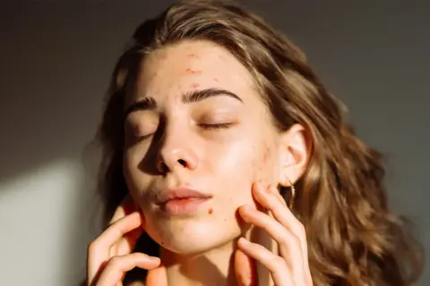 Ragazza con brufoli che si gode la luce del sole, sperando che il sole faccia bene ai brufoli.