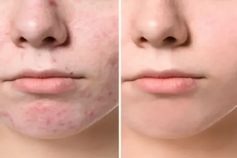 Confronto tra pelle con acne giovanile e pelle trattata, mostrando l'efficacia dei rimedi della nonna.
