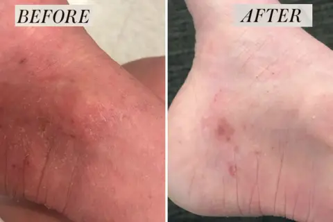 Piede prima e dopo: la pelle secca e screpolata migliora. Attenzione, le creme all'urea fanno male se usate impropriamente.