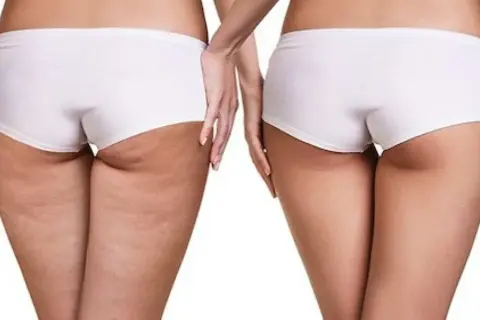 Confronto tra adipe e cellulite: la pelle a sinistra mostra la texture irregolare della cellulite, mentre a destra appare più liscia e tonica.