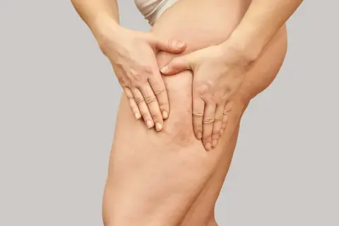Mani che stringono la coscia, evidenziando la **cellulite acquosa** e la texture della pelle.