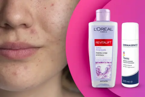 Viso con imperfezioni e due flaconi di tonico, uno L'Oréal Revitalift, l'altro Dermasence, per una pelle giovane e luminosa.