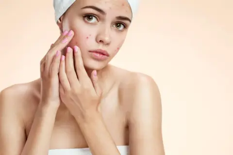 Ragazza con imperfezioni sul viso, preoccupata. Cerca una soluzione non comedogena per la sua pelle.
