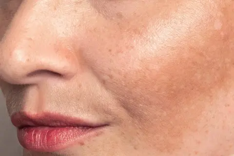 Primo piano del viso con macchie solari. La niacinamide può aiutare a ridurre le macchie solari e uniformare il tono della pelle.