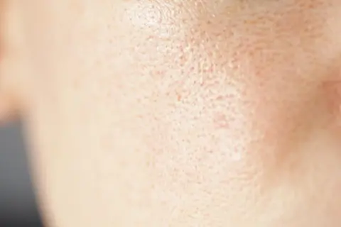 Primo piano della pelle del viso con pori dilatati sulle guance, evidenziando la texture.