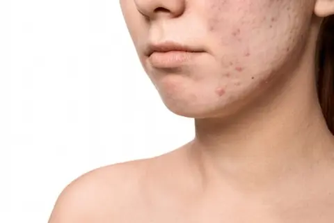 Primo piano di un volto con pelle congestionata e acne. Imperfezioni visibili sul mento e sulla guancia.