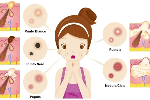 Ragazza preoccupata per i brufoli: punto bianco, punto nero, papula, pustola e nodulo/cisti illustrati.