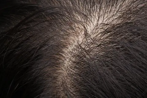 Primo piano del cuoio capelluto con capelli scuri e radi, che sembrano ruvidi al tatto.