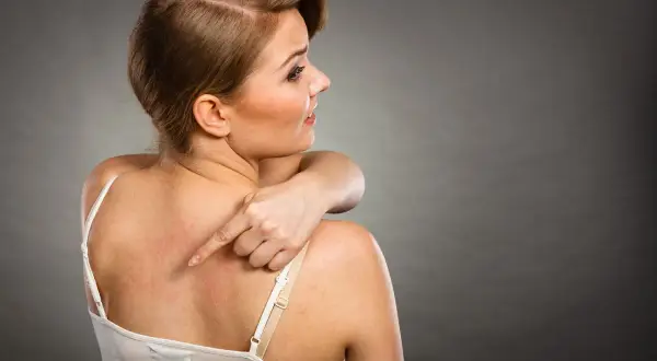 Donna si tocca la schiena arrossata, indicando un fastidioso punto nero che non esce.
