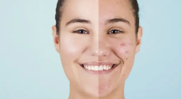 Volto diviso: da un lato pelle liscia e luminosa, dall'altro con brufoli e imperfezioni. Scopri i rimedi per i brufoli fatti in casa per una pelle radiosa.