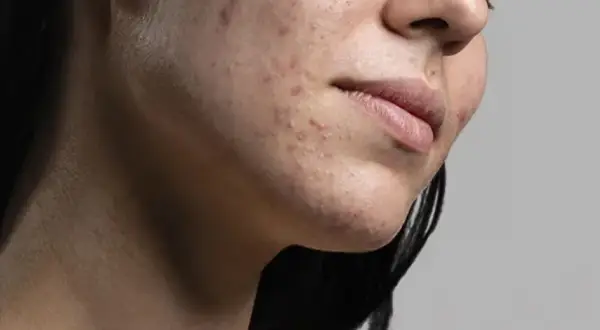 Primo piano del viso di una donna con acne. La resorcina cos'è? Un trattamento per la pelle.