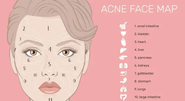 Mappa del viso per l'acne: i brufoli sulla mandibola (zona 9) potrebbero indicare problemi intestinali.