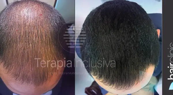 Prima e dopo: un uomo mostra come far ricrescere i capelli con un trattamento che ha ridensificato la chioma, eliminando la calvizie.