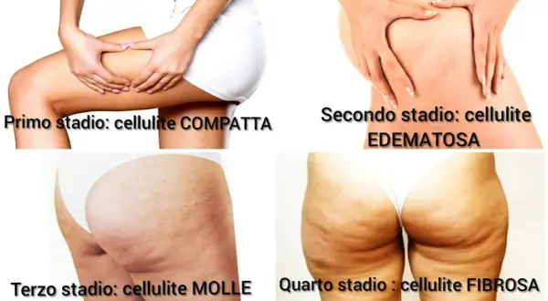 Le immagini mostrano i quattro stadi della cellulite, da compatta a edematosa, molle e fibrosa. La cellulite fa male e può peggiorare con il tempo.