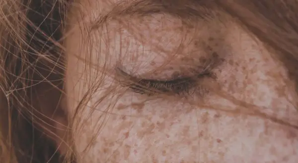 Primo piano di un occhio chiuso con capelli castani che sfiorano il viso. Le **macchie solari sulla pelle** creano un disegno naturale e unico.