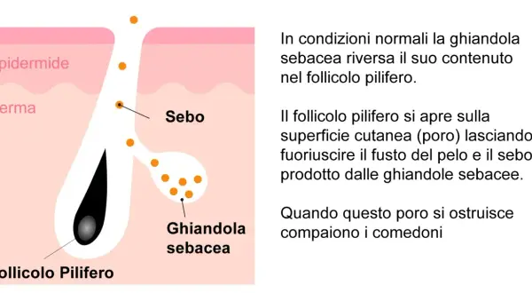 Diagramma della pelle che mostra un follicolo pilifero e una ghiandola sebacea. Punti neri giganti indicano l'accumulo di sebo.