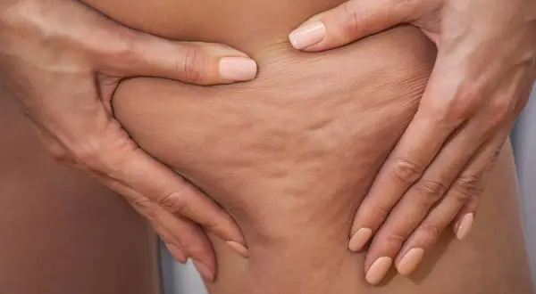 Mani che pizzicano la pelle mostrando la cellulite sclerotica, con unghie smaltate color pesca.