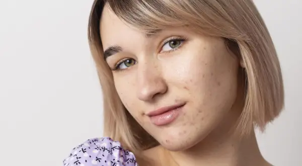 Primo piano di una giovane donna con brufoli da stress sul viso. Impara a riconoscerli e a gestirli.