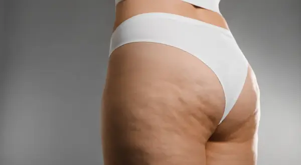 Gambe e glutei con cellulite di stadio avanzato, mostrando la texture della pelle. Ricerca di cellulite 4 stadio rimedi.