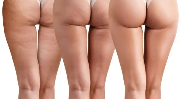Gambe con cellulite fibrotica visibile, che mostra la progressione verso una pelle più liscia.