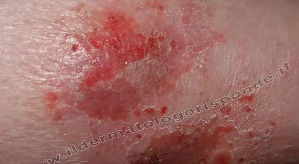 Macchie infiammate e screpolate sulle gambe, con aree arrossate e desquamazione.