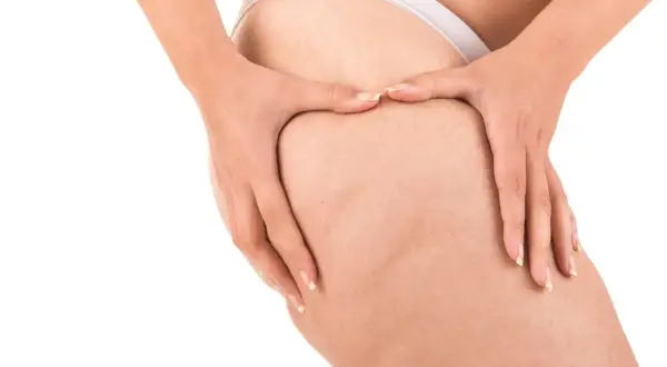 Mani che stringono la coscia per rompere i noduli di cellulite, mostrando la texture della pelle.